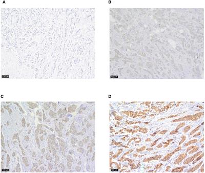 Interleukin 17 in early invasive breast cancer